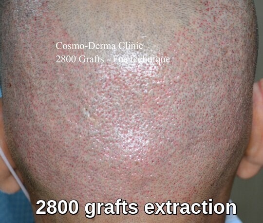 2800 Fue grafts extraction