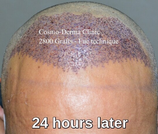 2800 grafts frontal area