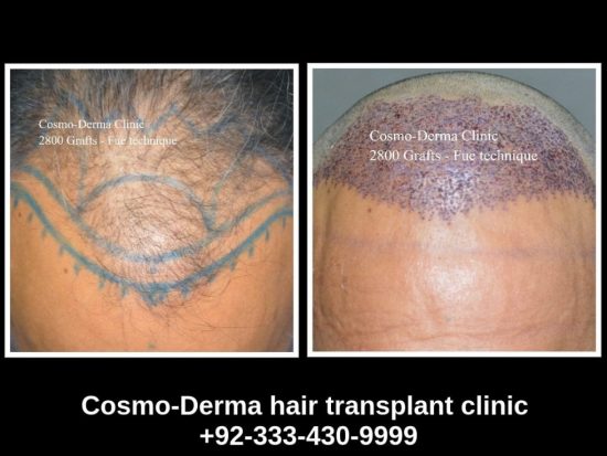 Read more about the article 2800 grafts hair transplant