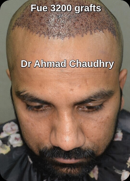 3200 grafts hair transplant post op day one