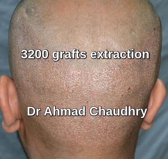 Fue donor area extraction after 24 hours Pakistan