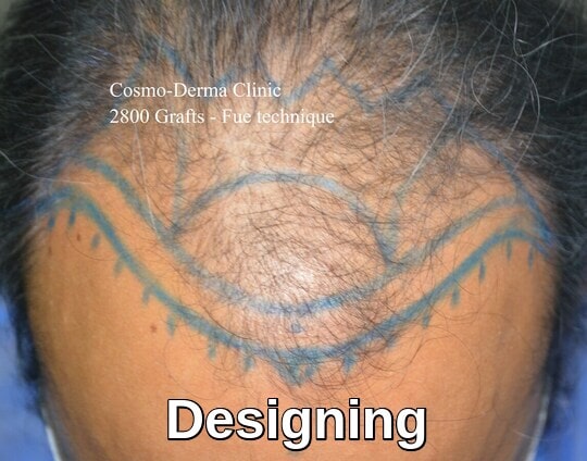 Hair loss treatment frontal area