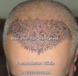 Read more about the article Hair after hair transplant