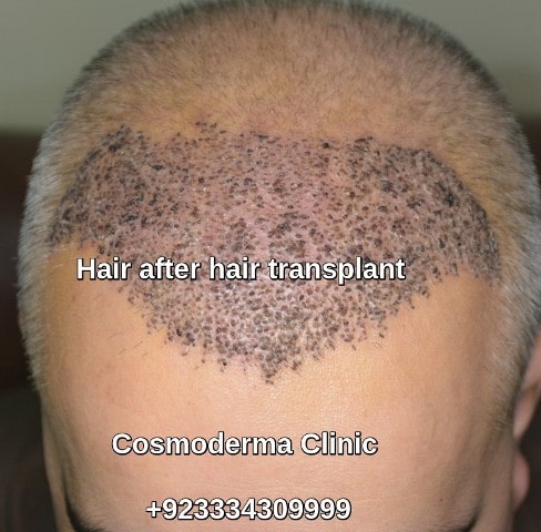 You are currently viewing Hair after hair transplant