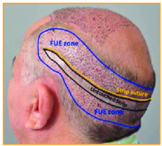 Hybrid hair transplant Lahore Pakistan