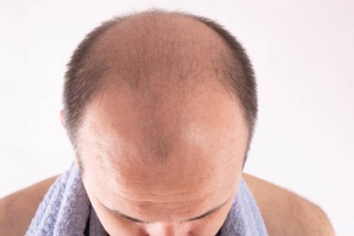 Baldness treatment Dubai