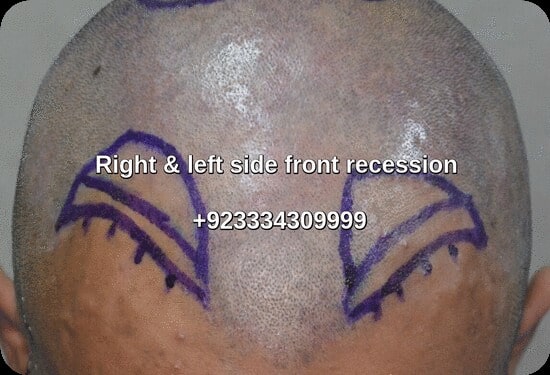 Hairline recession transplant Lahore -marking