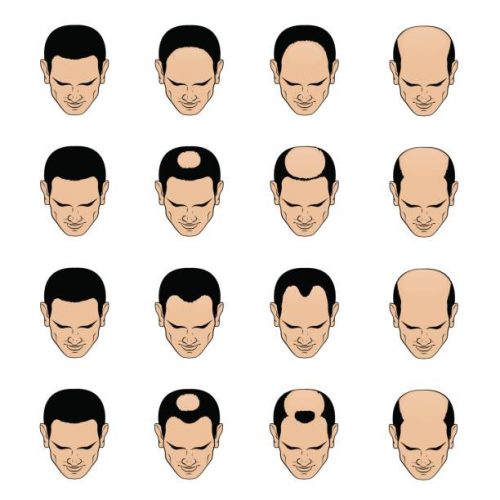 male pattern baldness types