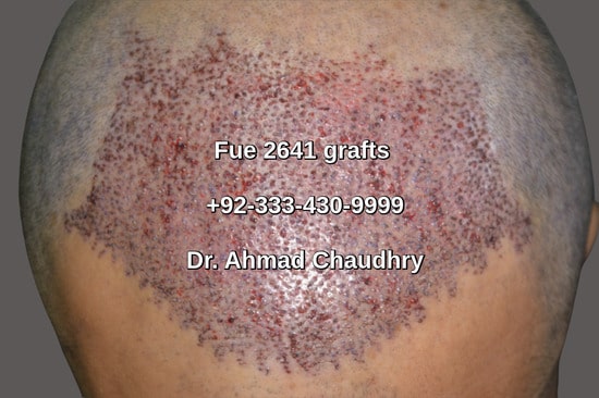 Fue hair transplant Australia patient