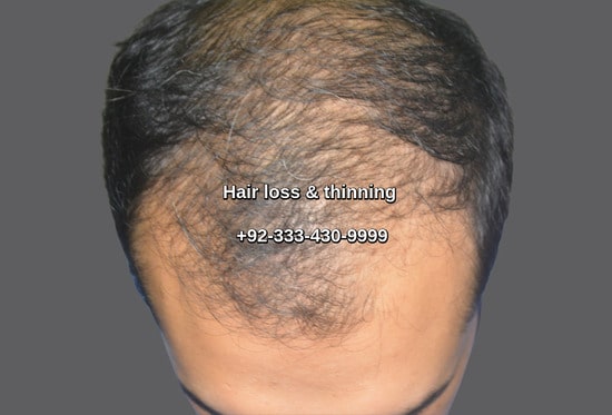 Hair loss Sydney patient