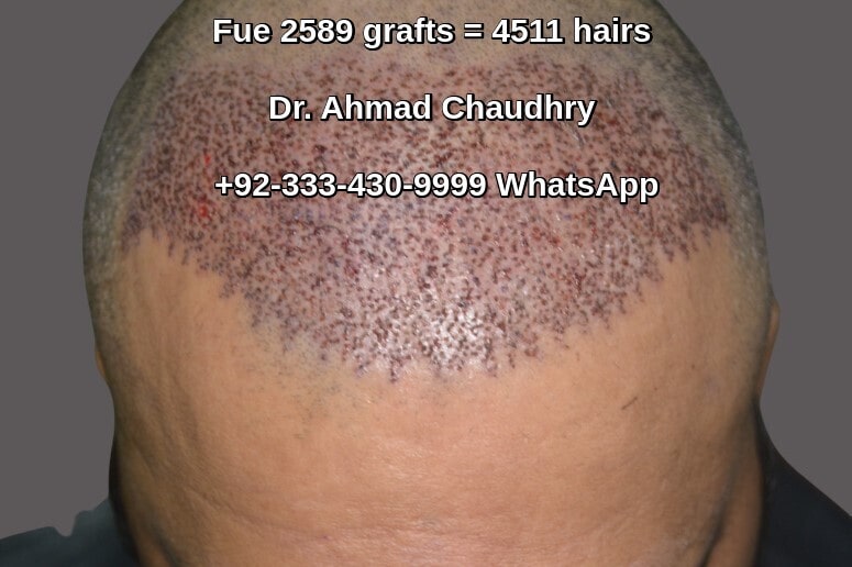 Laser hair transplant Lahore Pakistan