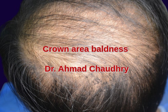 Crown baldness Toronto patient