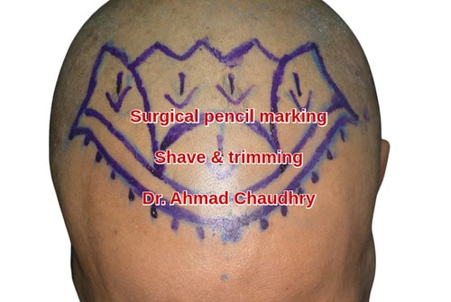 Fue hair transplant Lahore patient