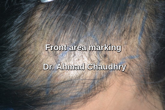 Left side marking before hair restoration