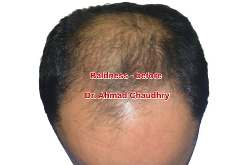 Male hair loss before treatment