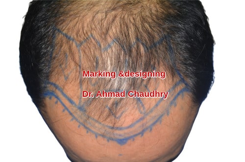 Marking before hair restoration procedure