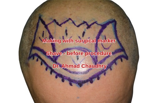 Shave before Fue hair transplant in Pakistan