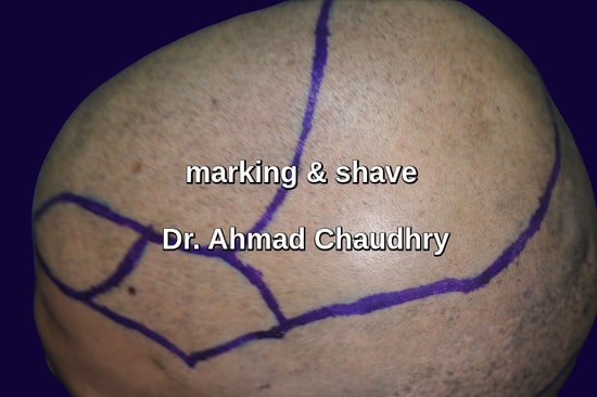 Shave -marking before hair transplant Canada patient