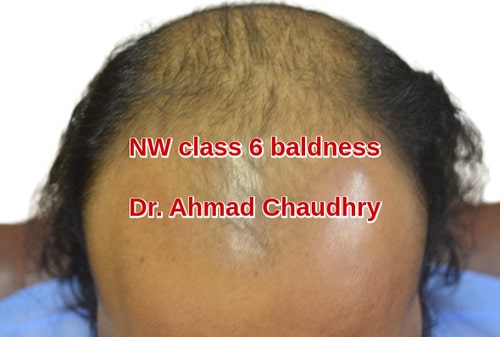 Wilson baldness
