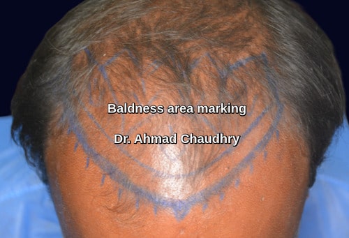 Baldness treatment are marking