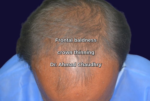 Hair transplant Nankana sahib patient
