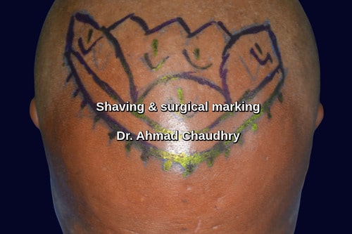 Shave before FUE hair transplant