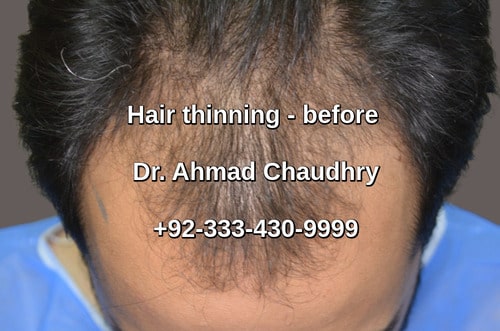 Hair transplant Belgium