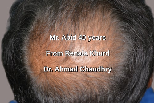 Hair transplant renala khurd