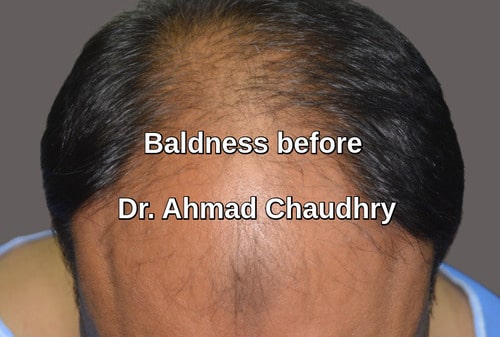 Inflammatory aspect of baldness