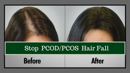 PCO hair loss