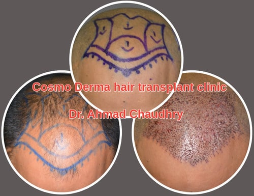Fue hair transplant Sialkot patient