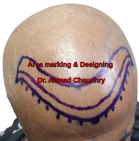 Baldness area marking