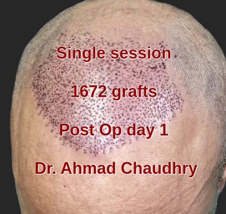 Hair graft transplant Lahore