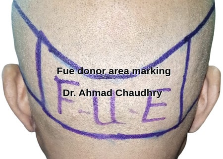 Hair restoration donor area marking Wapda town patient