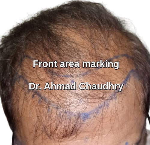 Hair transplant Wapda town Lahore