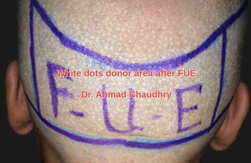 Side effects of hair transplant white dots