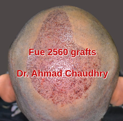 Transplantation hair Lahore clinic