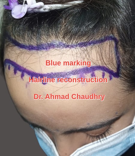 Woman hairline reconstruction