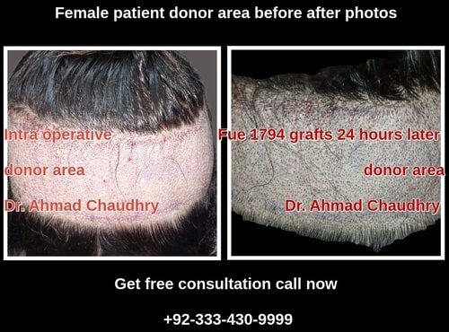 woman Fue donor area before after photo
