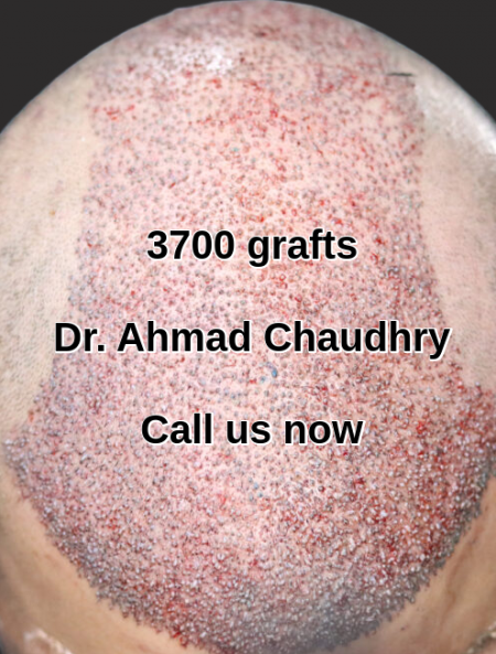 Hair replacement surgically Lahore