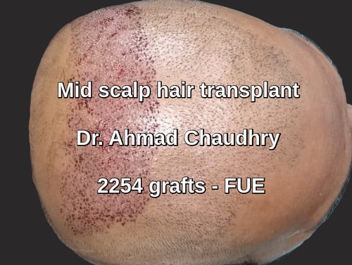 Hair transplant Pakistan cost