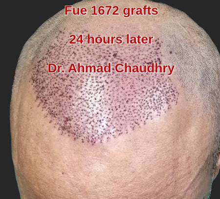 Hair transplant Shalimar town Lahore