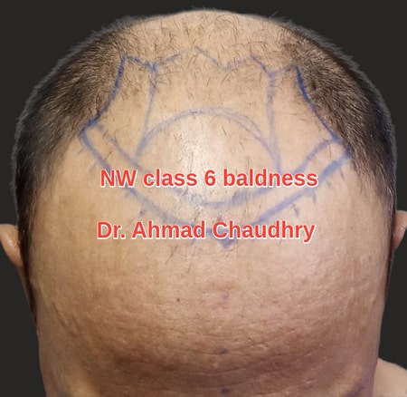 NW class six baldness treatment Lahore