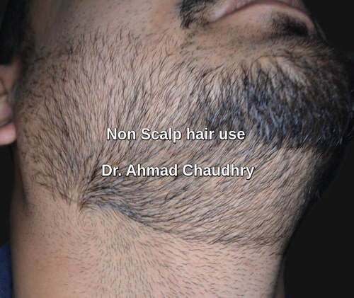 Non scalp hair transplants Lahore Pakistan