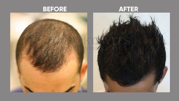 PRP treatment for hair regrowth Lahore