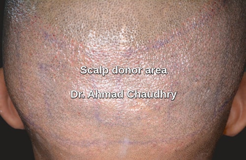 Scalp donor area