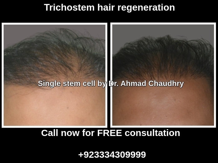 stem cell hair treatment result Lahore Pakistan
