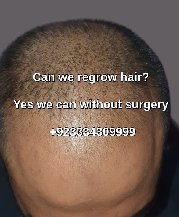 Hair restoration clinic Oman patient