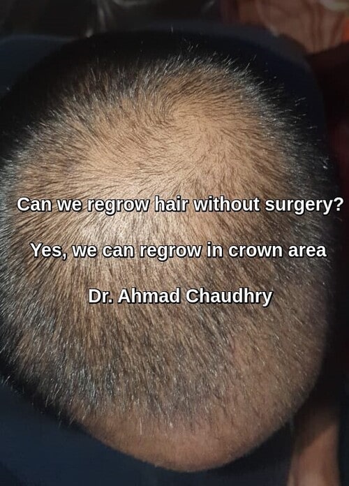 Stem cell hair regrowth treatment Lahore Pakistan