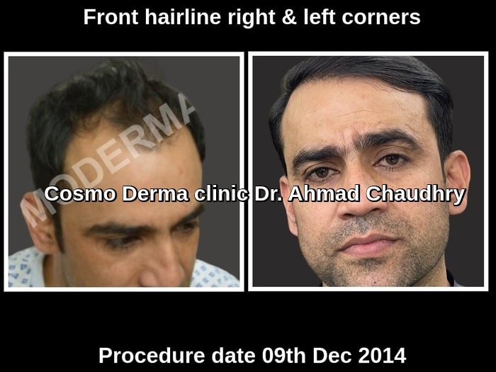 Real hair patch Vs permanent hair transplant result Lahore